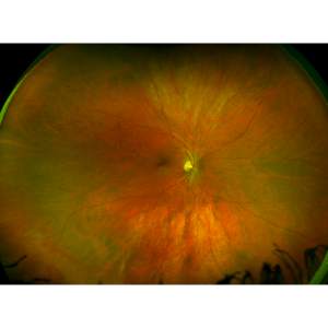 color-healthy-retina-california